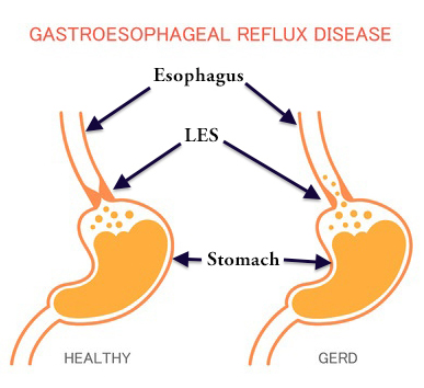 Gastroesophageal reflux disease how to treat