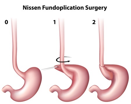 acid reflux surgery