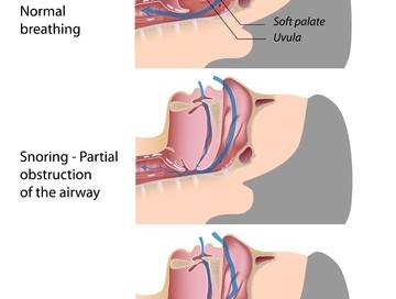 sleep apnea