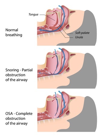 sleep apnea and diet