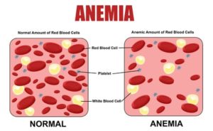 Iron Deficiency Anemia – Overview and Treatment Options