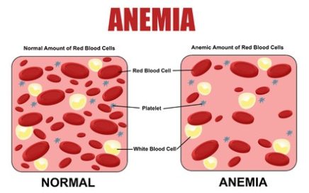 Iron Deficiency Anemia – Overview and Treatment Options