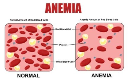 Anemia