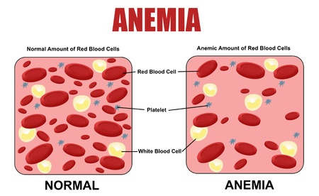 anemia plant-based diet