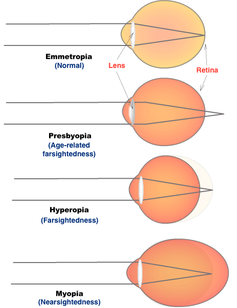 vision disorders