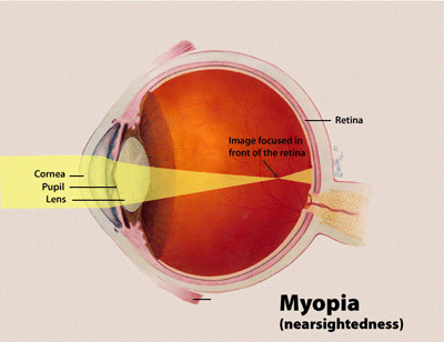 myopia and CRT lenses
