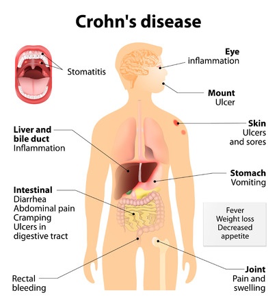 crohn's disease signs and symptoms