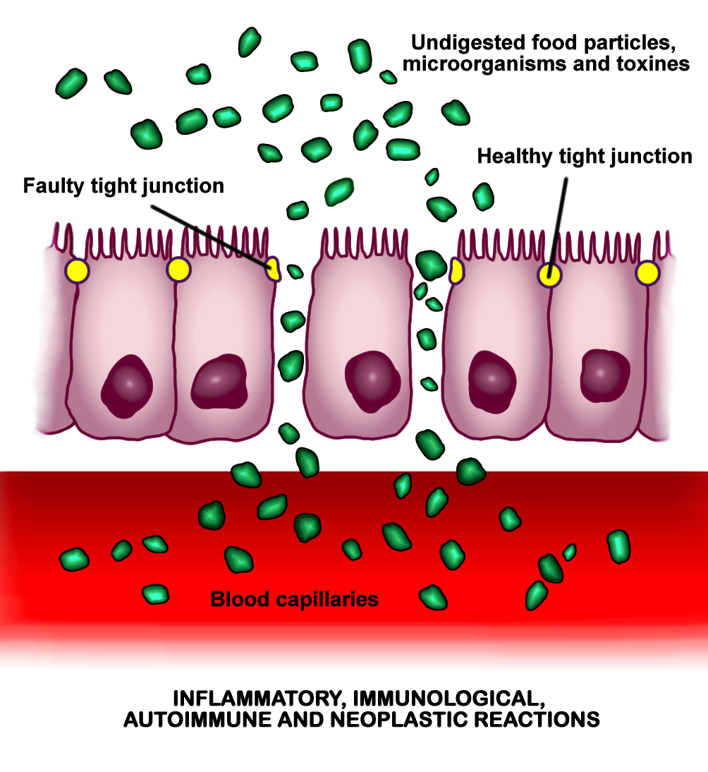 crohn's disease leaky gut