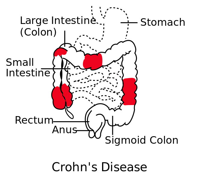 crohn's disease drug treatment