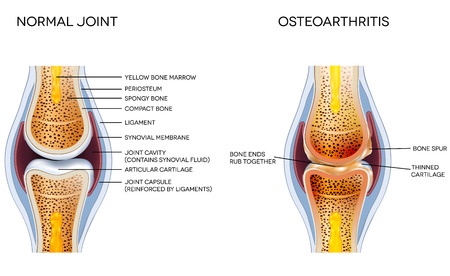 normal joint versus osteoarthritis