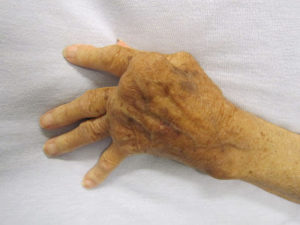 rheumatoid arthritis treatment